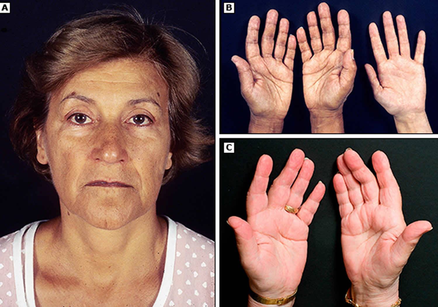 What Is Addison S Disease Symptoms Causes Diagnosis Treatment And What Is Addison S Disease Symptoms Causes Diagnosis Treatment And